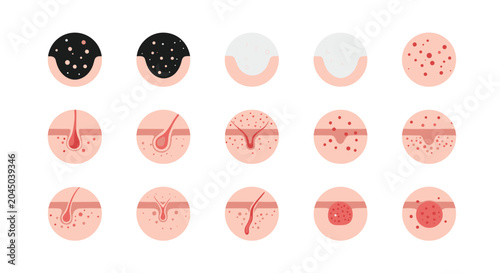 Various types of skin conditions and acne diagrams showing blackheads, whiteheads, and pimples for dermatology education.