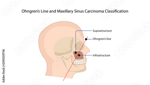 Fotografi Ohngren’s Line and Maxillary Sinus Carcinoma Classification demonstrating Ohngre