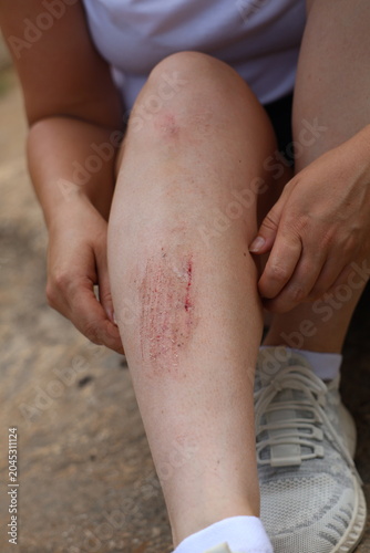 Obraz na plátne A fresh, bleeding abrasion or laceration on a person's skin following a fall