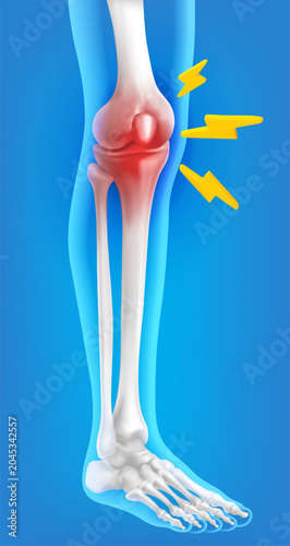 Bild auf Leinwand 3D vector Human kneecap model arthro phlogosis joint swelling joint pain