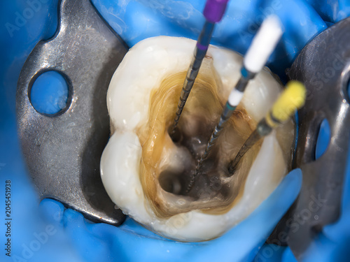 Molar tooth undergoing a root canal treatment, with endodontic instruments cleaning and shaping infected pulp canals, highlighting advanced dental care and precision, isolated on transparent backgroun