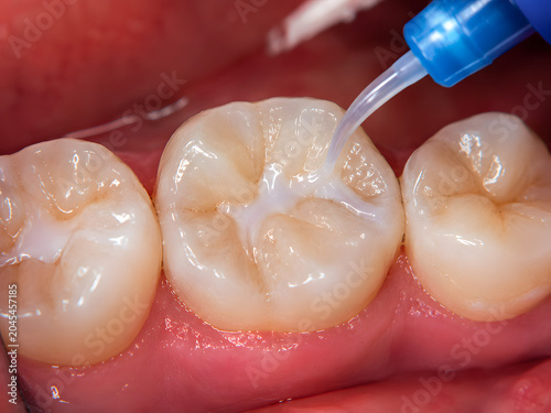 Dental professional applying a protective sealant onto a molar tooth with an applicator, highlighting modern preventive dentistry, isolated on transparent background.