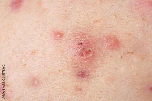 Slika na platnu Pores on acne skin texture