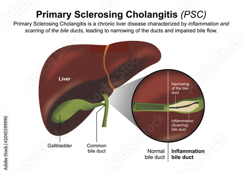 Fotografía Primary Sclerosing Cholangitis (PSC) Flashcard