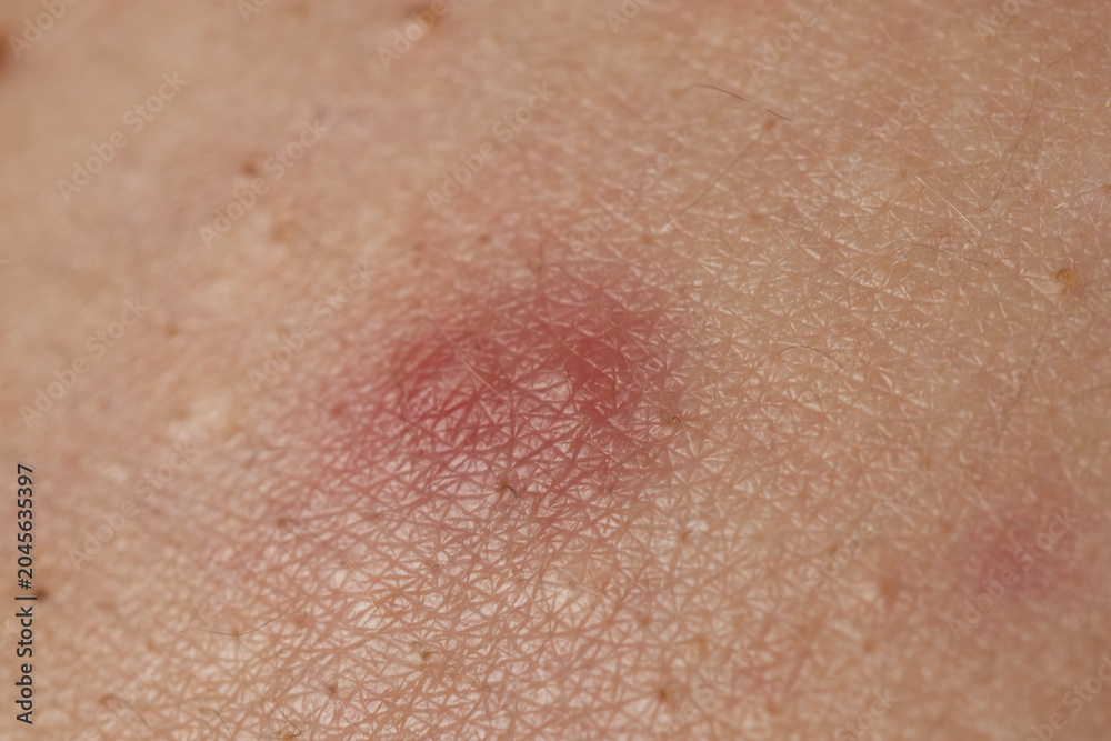 Fototapeta premium Skin rash texture with acne. Inflamed skin bumps acne macro. Macro shot of skin irritation with acne. Irritated acne skin.