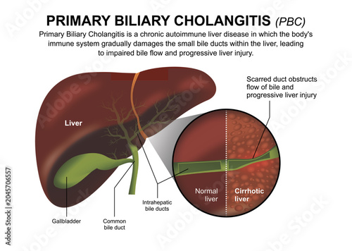 Fényképezés Primary Biliary Cholangitis (PBC) Liver Flashcard