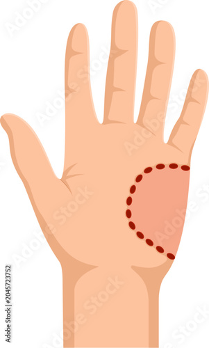 Illustration of Palm with Medical Markings