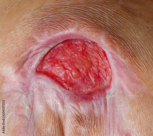 Quadro su tela Close-up macro shot of a deep pressure ulcer (bed sore) on human skin, showing red granulation tissue and surrounding scar tissue