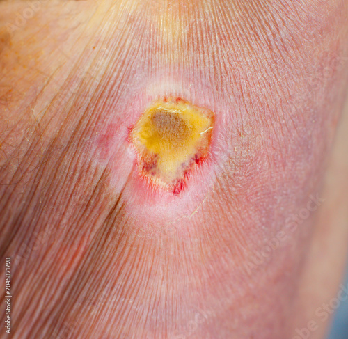Foto Macro photograph of a deep pressure ulcer (bed sore) on human skin showing red g