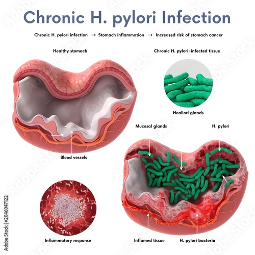 Detailed illustration of chronic helicobacter pylori infection affecting stomach anatomy and tissues