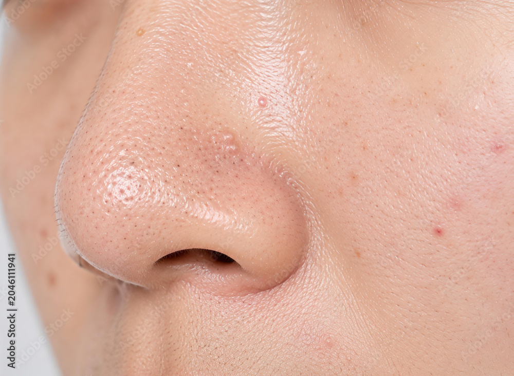 Fototapeta premium Extreme close up of human nose skin with blackheads and clogged pores