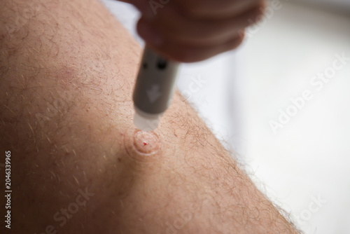 Schilderij op canvas A man injects himself in the leg using a prefilled injection pen