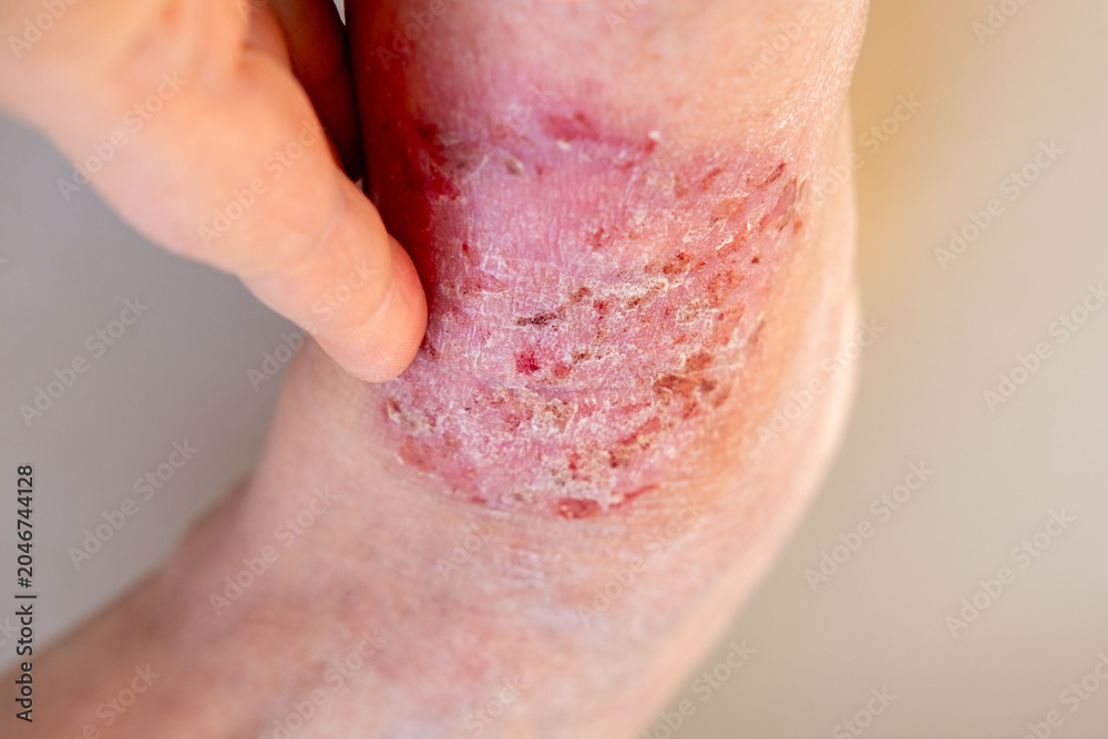 Fototapeta premium doctor treats large healing wound from lower leg with scars adult female patient, redness, diabetes disease, scarring skin, medical care, human tissue regeneration, hives and other skin manifestations