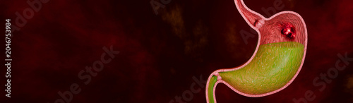 Foto Aggressive Cancer Cells Expanding Across Stomach Lining Causing Gastric Disease