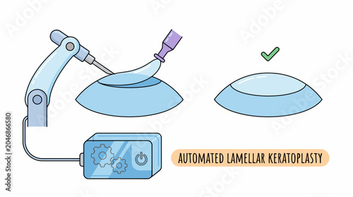 Εκτύπωση καμβά Automated Lamellar Keratoplasty (ALK) illustration