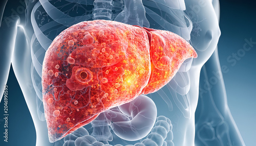 Fatty Liver Disease and Liver Damage Medical Illustration