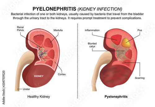 Photos Kidney Infection (Pyelonephritis) Flashcard Illustration