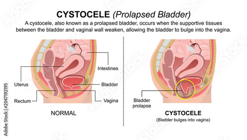 Photos Cystocele (Prolapsed Bladder) Flashcard Illustration