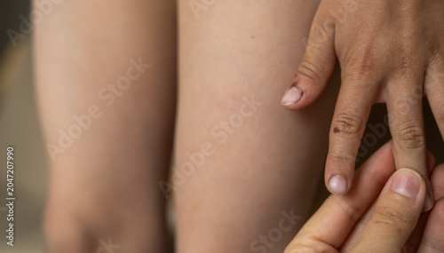 Photos Close-up of a parent holding a child hand after a minor finger injury