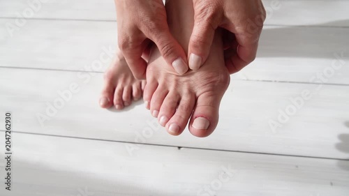 Female foot suffers from inflammation of the big toe bone. Hallux valgus, bunion in foot on white background. Close up