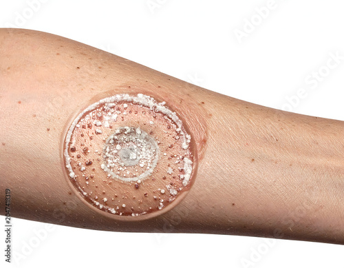 Close-up of a wound with a medical dressing on a human arm, showing a bandage applied to treat an injury.