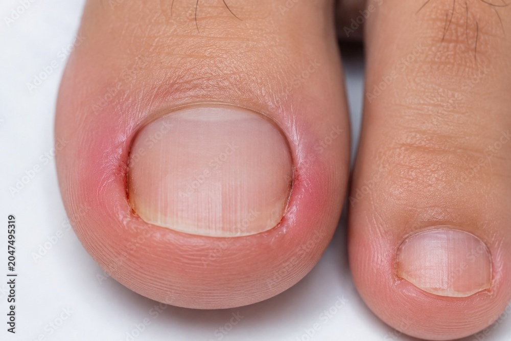 Fototapeta premium Ingrown Toenail on Big Toe