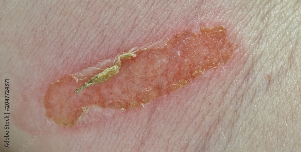 Fototapeta premium Burn injury on caucasian arm beginning to heal. Medical condition with redness and swelling.