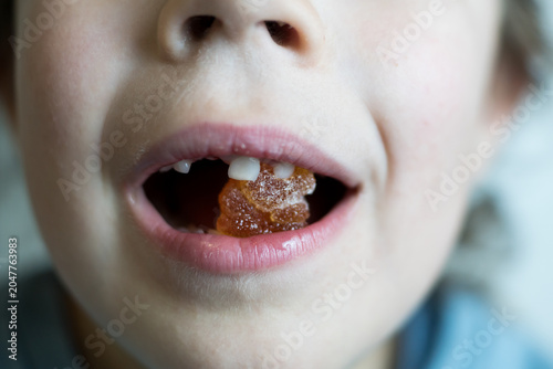 Cuadro en lienzo Frontal close-up of a child's mouth open with an orange gummy bear inside, clearly showing missing front teeth during the dental development stage
