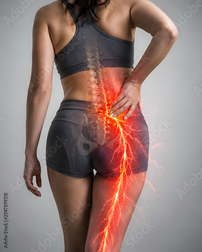 Conceptual medical image of sciatic nerve pain in lower back