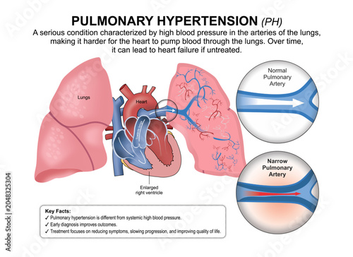 Pulmonary Hypertension (PH) Flashcard Illustration