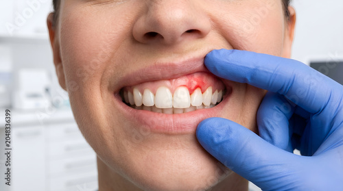 Close-up of a woman's mouth with red, inflamed gums being examined by a gloved hand