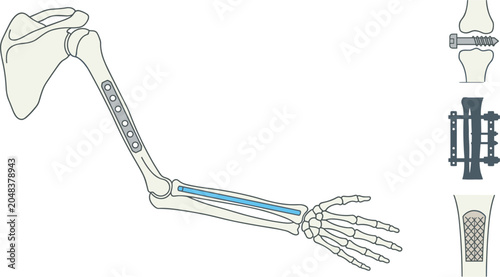 Schilderij op canvas Forearm Bone Fracture Fixation Anatomy Illustration with Orthopedic Implant Plat