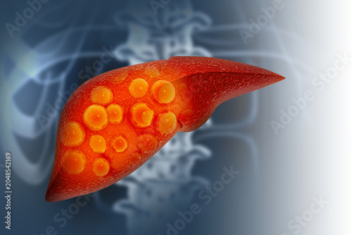 Liver damage such as Fatty liver, Fibrosis, Cirrhosis, and Liver cancer. 3d illustration