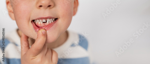 Photography A preschool boy shows the hole where his baby tooth fell out
