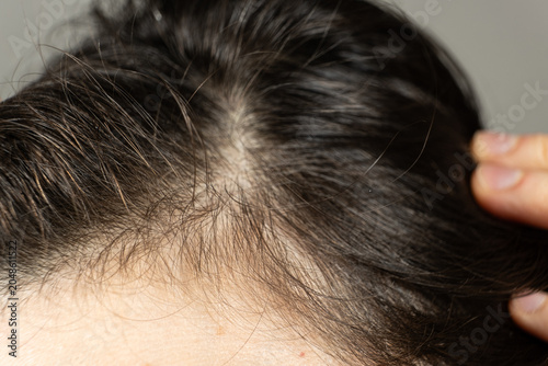 Female scalp close-up showing visible results of active hair regrowth and recovery.