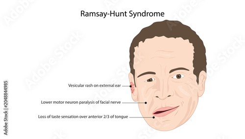 Tableau sur toile Ramsay Hunt Syndrome and Facial Nerve Palsy, characteristic clinical features of Ramsay Hunt syndrome, including facial paralysis, inability to close the eye, and drooping of the mouth