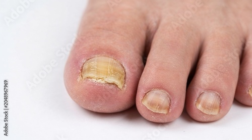  Nail fungus