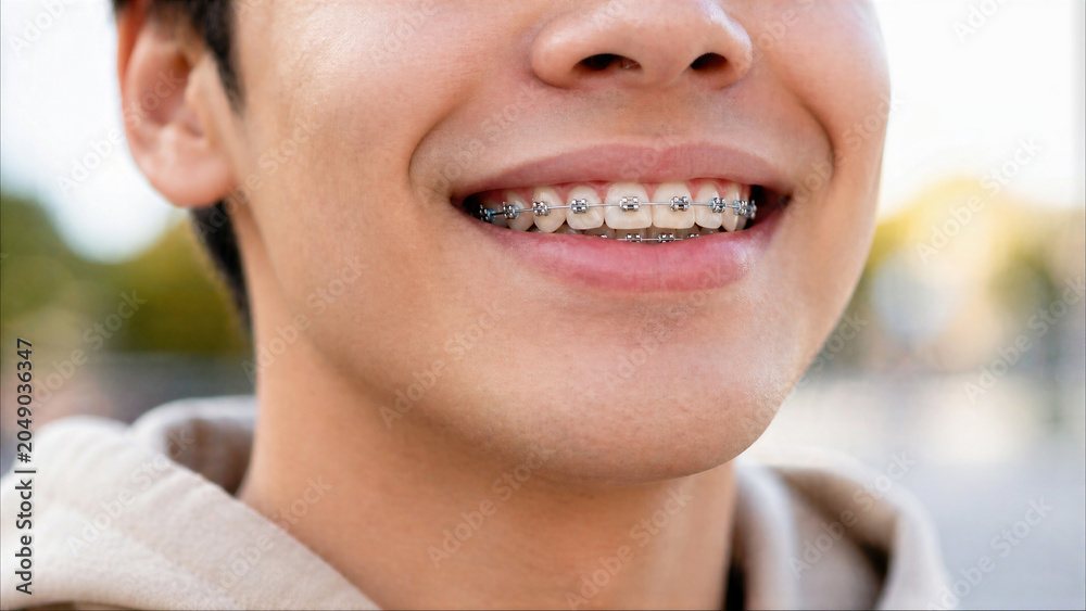 Obraz premium Close-up portrait of a young man smiling with traditional metal dental braces on his teeth