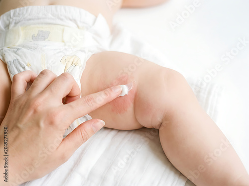 Parent applying diaper rash cream to baby's irritated skin