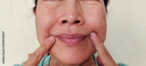 portrait the fingers holding the flabbiness and wrinkles, smile lines and scar beside the mouth, swelling and ptosis under the eyes, health care and beauty concept.