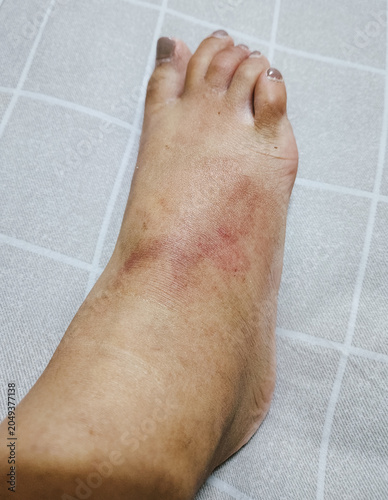 Swollen foot and bruised ankle after injury close-up view