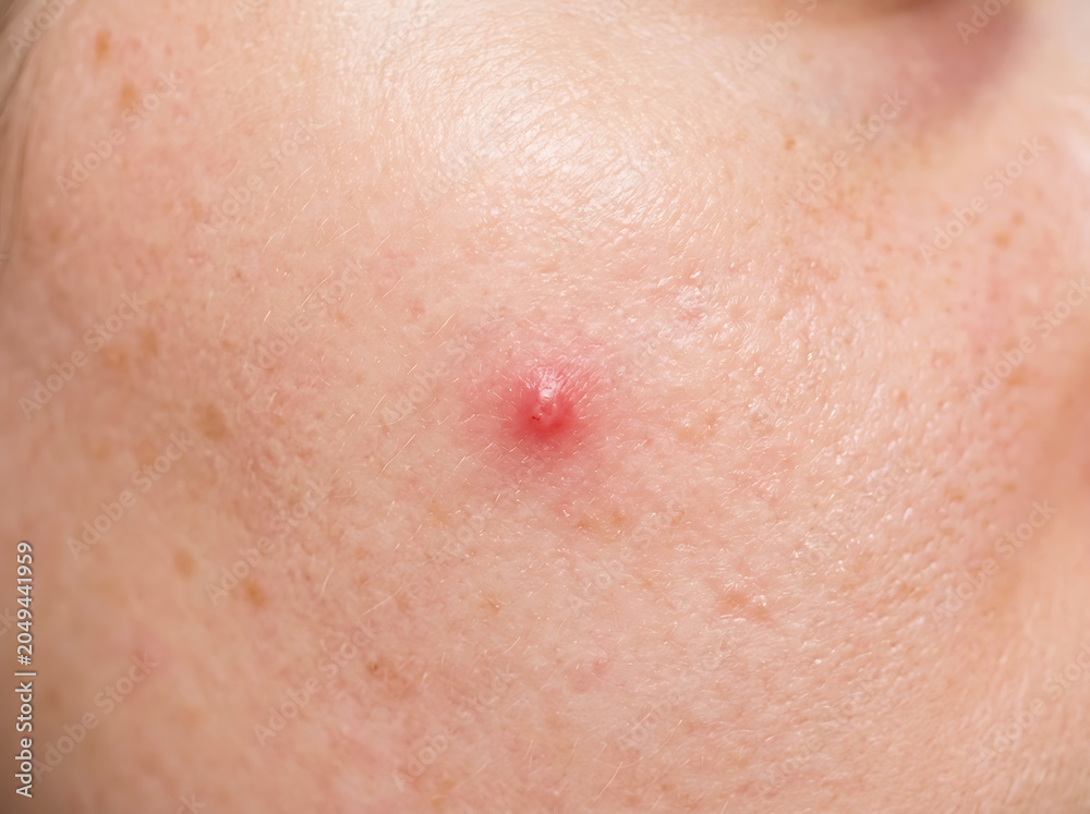 Fototapeta premium Extreme close up of human skin with a red inflamed acne pimple macro