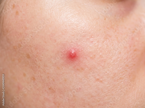 Extreme close up of human skin with a red inflamed acne pimple macro