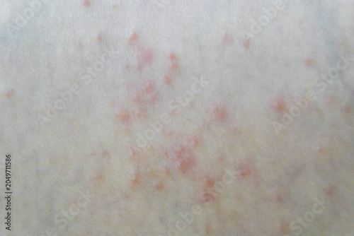 Foto Red rash skin, showcasing the irritated area with inflamed patches