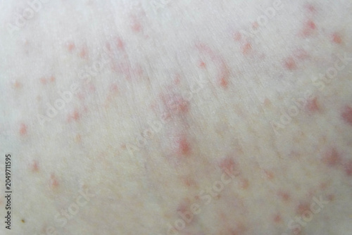 Tableau sur toile Red rash skin, showcasing the irritated area with inflamed patches