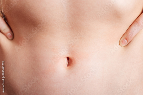 Quadro su tela Close up of child abdomen with irritated navel and skin redness