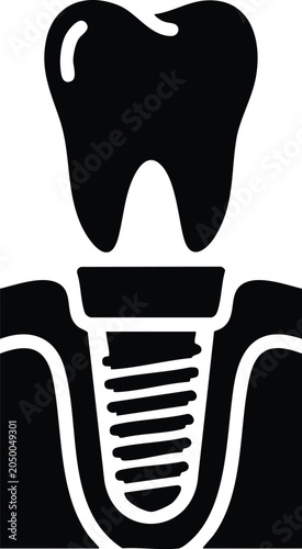 Canvas Print Tooth implant in jawbone dental surgery illustration.