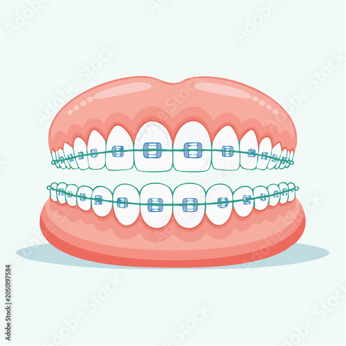 Dental Braces on Teeth