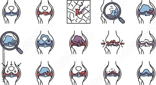 Tableau sur toile Set of medical knee joint icons illustrating arthritis and inflammation stages