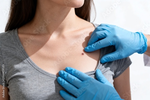 Medical Examination of Skin Lesion on Woman's Chest
